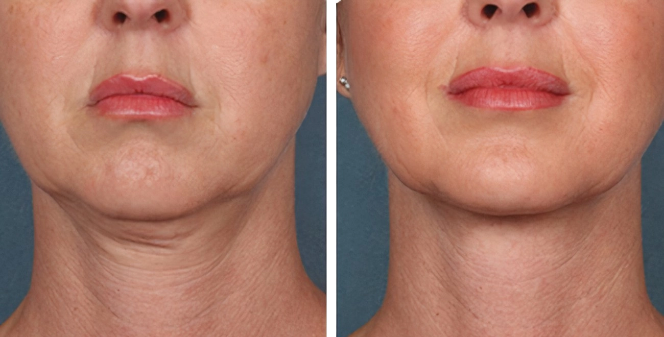 Resultados del HIFU Lifting facial y remodelación corporal
